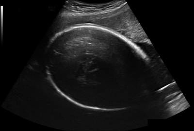 Sample image from Fetal Head UltraSound
