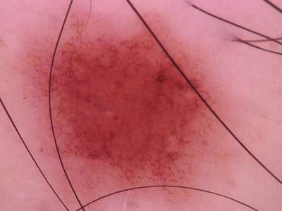 Sample image from Skin Cancer: HAM10000