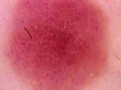 Sample image from Skin Cancer: HAM10000