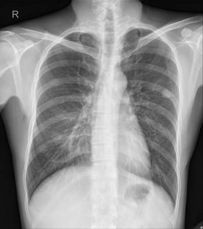 Sample image from Chest Xray Masks and Labels