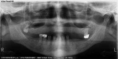 Sample image from Teeth Segmentation on Dental X-ray Images