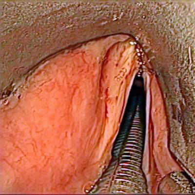 Sample image from Laryngeal Endoscopic