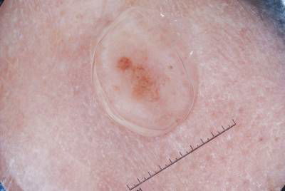 Sample image from ISIC 2017: Part 1 - Lesion Segmentation
