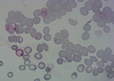 Sample image from P. Vivax (Malaria) Infected Human Blood Smears