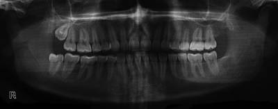 Sample image from Panoramic Dental X-rays