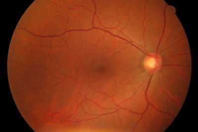 Sample image from High Resolution Fundus