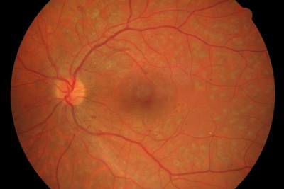 Sample image from High Resolution Fundus