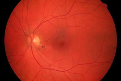 Sample image from High Resolution Fundus