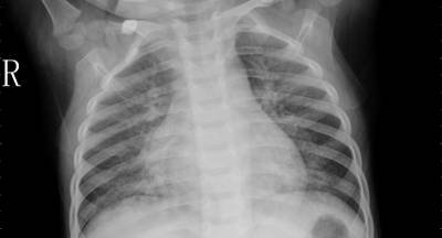 Sample image from ZhangLabData: Chest X-Ray