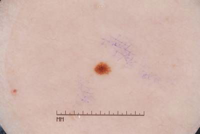 Sample image from ISIC 2017: Part 1 - Lesion Segmentation