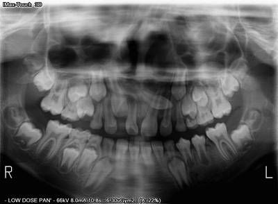 Sample image from Teeth Segmentation on Dental X-ray Images