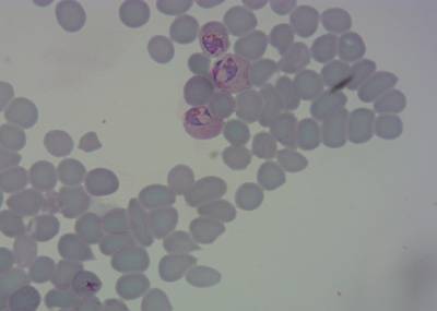 Sample image from P. Vivax (Malaria) Infected Human Blood Smears