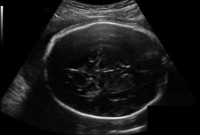 Sample image from Fetal Head UltraSound