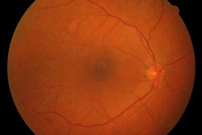 Sample image from High Resolution Fundus