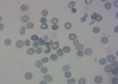 Sample image from P. Vivax (Malaria) Infected Human Blood Smears