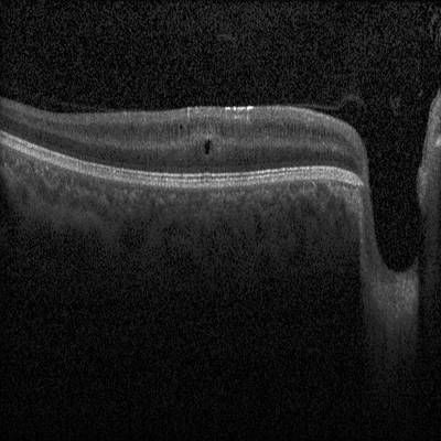 Sample image from Intraretinal Cystoid Fluid