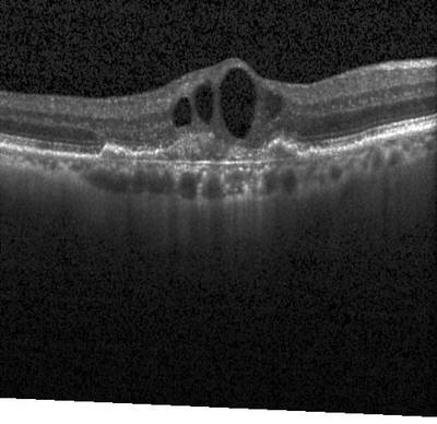Sample image from ZhangLabData: OCT