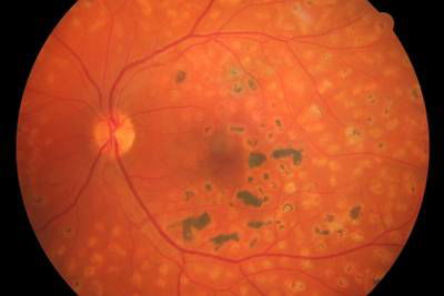 Sample image from High Resolution Fundus