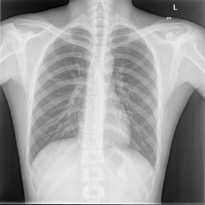 Sample image from Chest Xray Masks and Labels