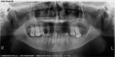 Sample image from Teeth Segmentation on Dental X-ray Images