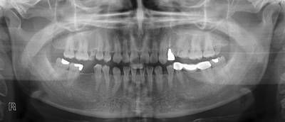 Sample image from Panoramic Dental X-rays