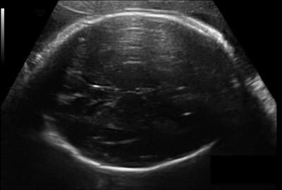 Sample image from Fetal Head UltraSound