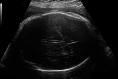 Sample image from Fetal Head UltraSound