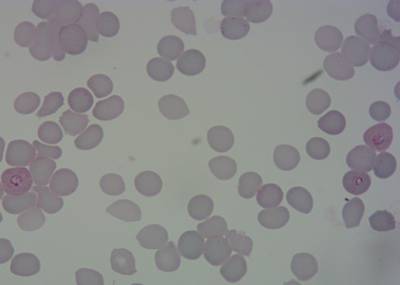 Sample image from P. Vivax (Malaria) Infected Human Blood Smears