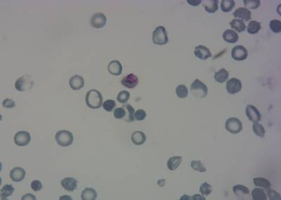 Sample image from P. Vivax (Malaria) Infected Human Blood Smears