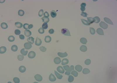 Sample image from P. Vivax (Malaria) Infected Human Blood Smears