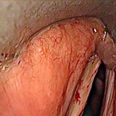 Sample image from Laryngeal Endoscopic