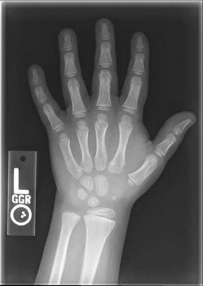 Sample image from RSNA Bone Age 2017