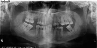 Sample image from Teeth Segmentation on Dental X-ray Images