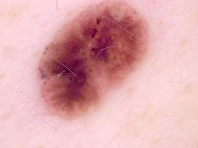 Sample image from Skin Cancer: HAM10000