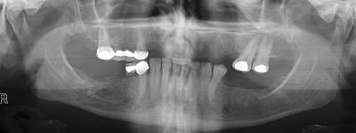 Sample image from Panoramic Dental X-rays