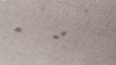 Sample image from Accurate Nevus Shapes