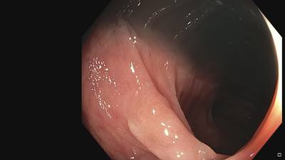 Sample image from Fine Grained Polyp