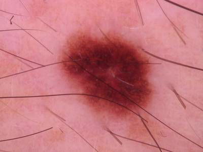 Sample image from Skin Cancer: HAM10000