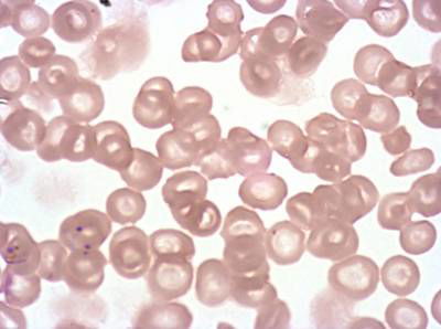 Sample image from Plasmodium Falciparum from Images of Giemsa for Malaria Detection