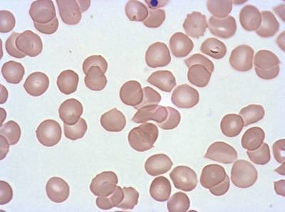 Sample image from Plasmodium Falciparum from Images of Giemsa for Malaria Detection