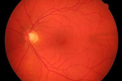 Sample image from High Resolution Fundus