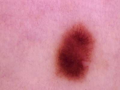 Sample image from Skin Cancer: HAM10000