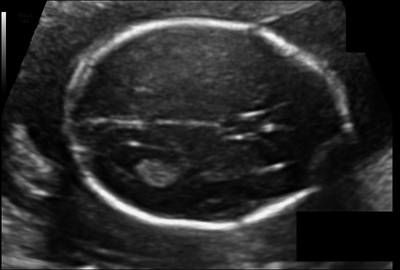 Sample image from Fetal Head UltraSound