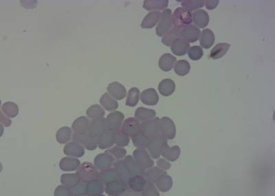 Sample image from P. Vivax (Malaria) Infected Human Blood Smears