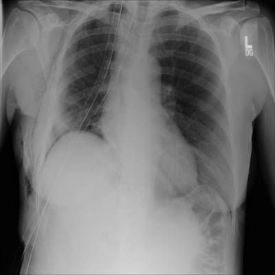 Sample image from SIIM-ACR Pneumothorax Segmentation 2019
