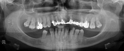 Sample image from Panoramic Dental X-rays