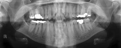 Sample image from Panoramic Dental X-rays