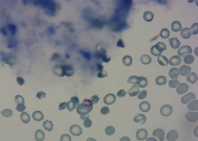 Sample image from P. Vivax (Malaria) Infected Human Blood Smears