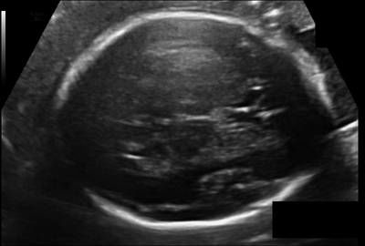 Sample image from Fetal Head UltraSound