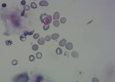 Sample image from P. Vivax (Malaria) Infected Human Blood Smears